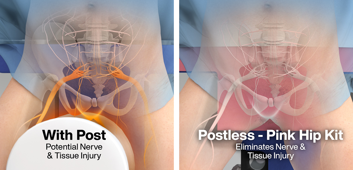 The Pink Hip Kit - Postless Hip Positioning System by Xodus Medical