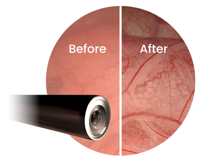 LAPAROSCOPIC VIEW before and after